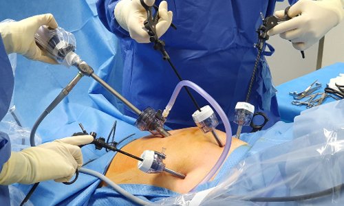 Laparoscopy & Hysteroscopy in Nagpur