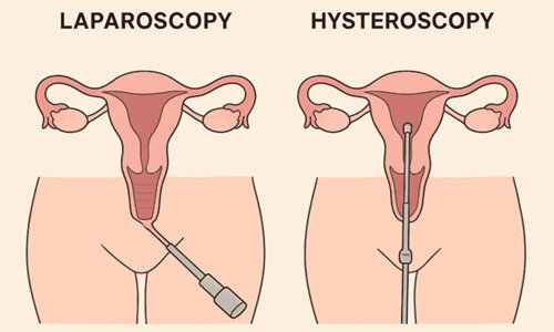Laparoscopy & Hysteroscopy in Nagpur